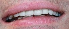 veneers | porcelain veneers | vienna va