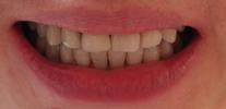 a smile after being treated with invisalign at our vienna dental office