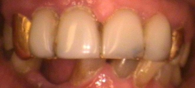 a smile featuring gold crowns | dental crowns vienna va