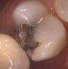 a tooth with a broken silver filling | dentist in vienna