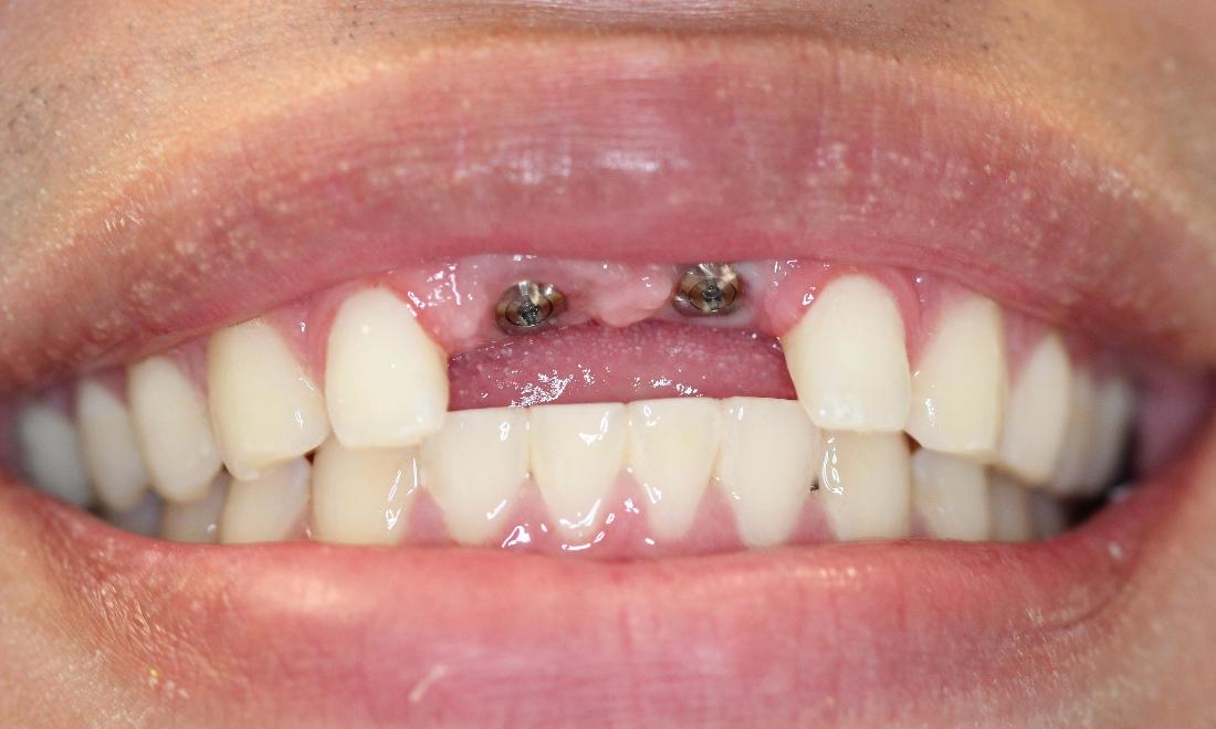 two front, upper implant posts, without crowns | dental implants vienna va