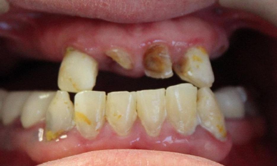 a patient's upper set of teeth, before having a hybrid denture crafted from our vienna dental office