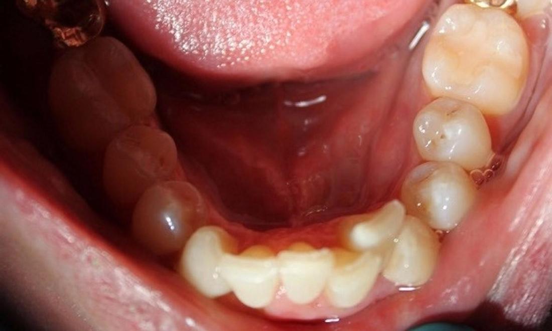 crowded teeth pre-invisalign treatment | invisalign vienna va