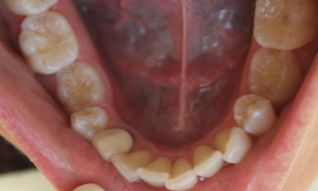 crowded lower front teeth | invisalign dentist vienna