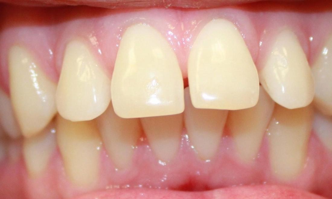 upper front teeth before invisalign, showing a slight gap | invisalign in vienna virginia