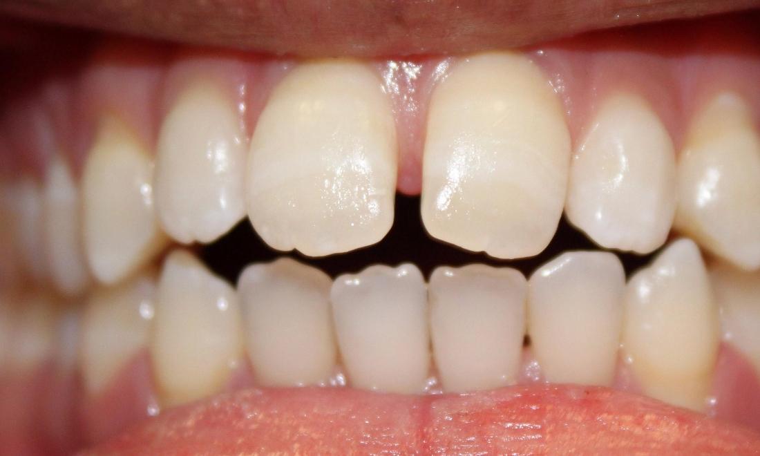 a patients upper front teeth before invisalign with tysons dentistry | invisalign in vienna
