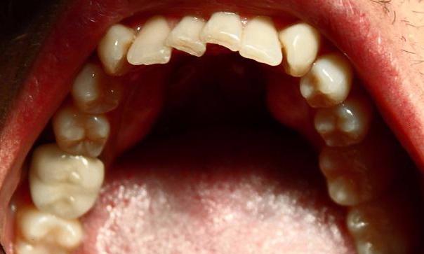 crowded lower teeth before an invisalign treatment | vienna va invisalign dentistry