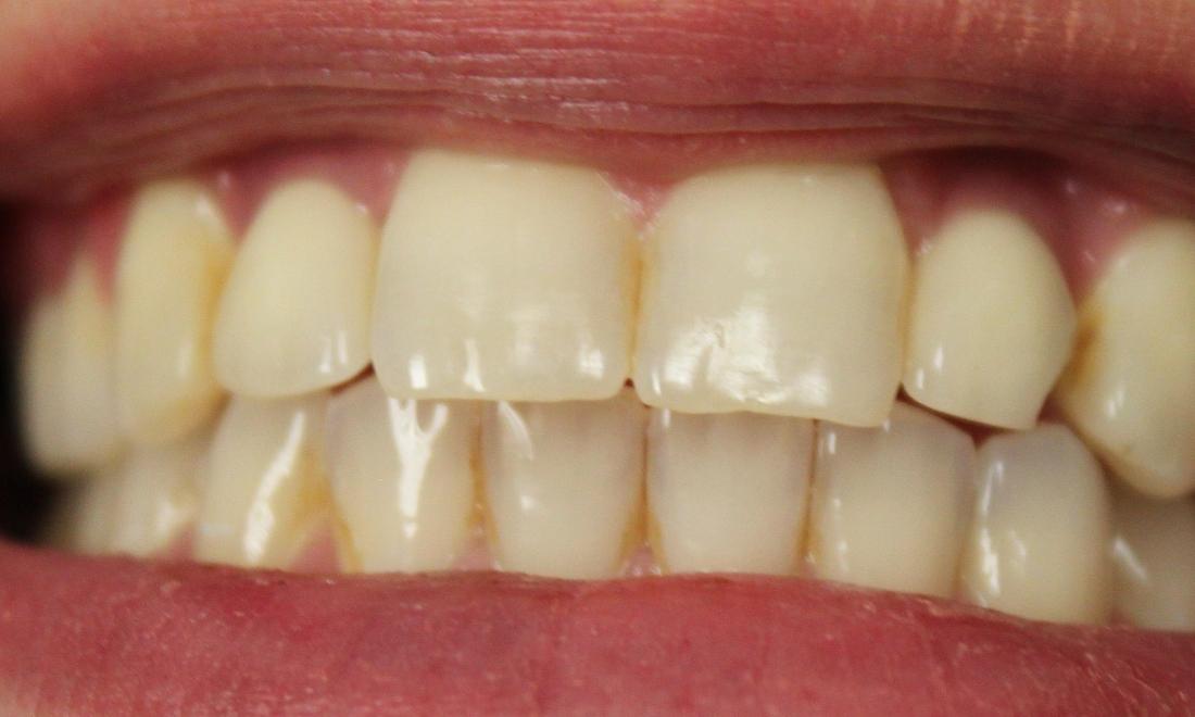 teeth before a laser whitening treatment | vienna teeth whitening dentist