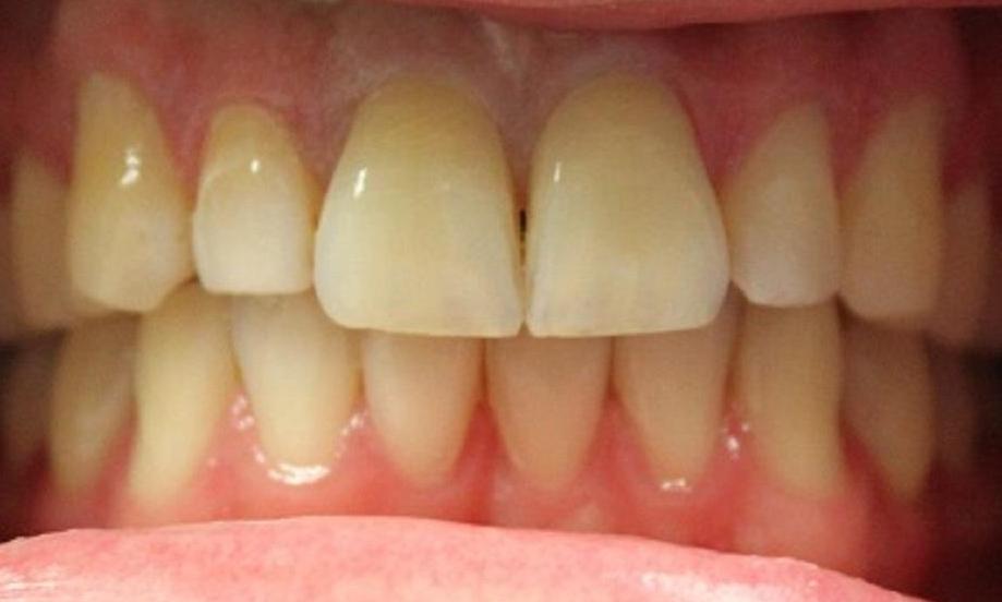 teeth before laser whitening at our vienna office | laser teeth whitening vienna