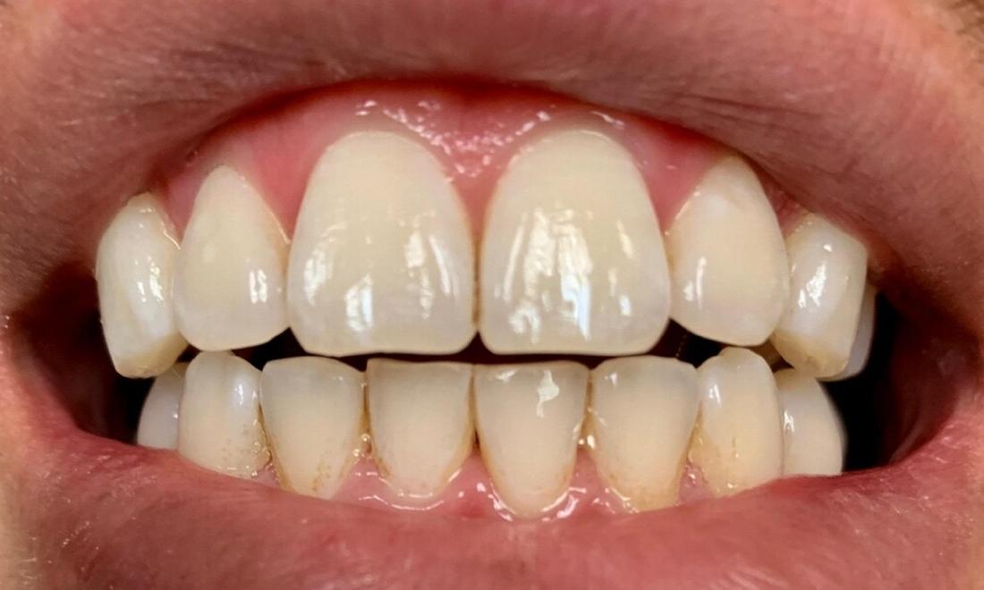 teeth whitening | vienna va 