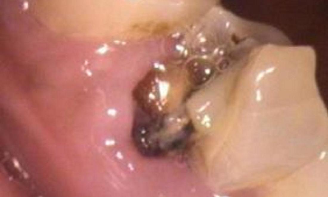 dental crown | vienna va | tysons dentistry 