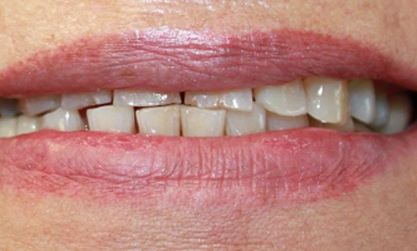 a set of teeth before crowns | dental crowns vienna va