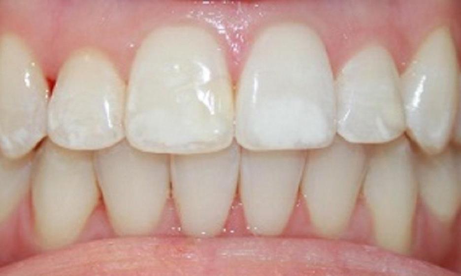 teeth with white spots | dentist in vienna va