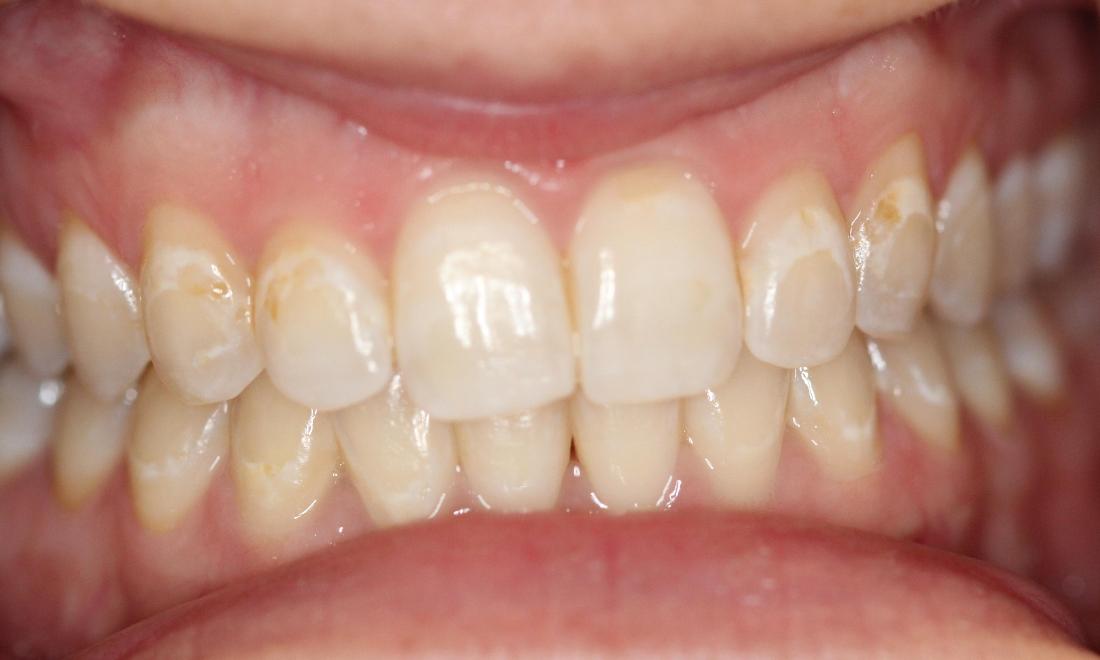 Tysons Dentistry's Smile Gallery Resin Infiltration