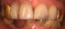 a smile featuring gold crowns | dental crowns vienna va