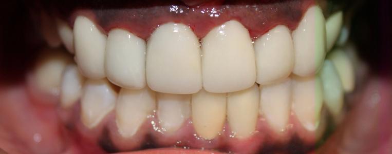 a patient with uniform dental crowns 