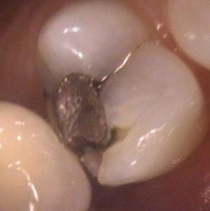 a tooth with a broken silver filling | dentist in vienna