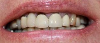 a patient with old crowns and bridge that had gaps between the gumline and the teeth | crowns and bridges vienna va