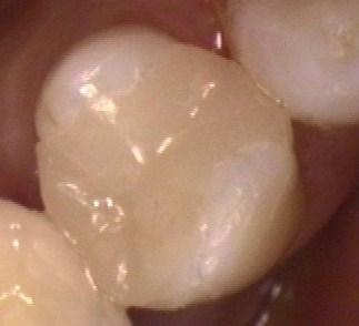 a tooth that has had a broken silver filling removed and replaced with a porcelain on-lay | dentist in vienna va