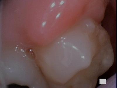 gum with a growth | laser dentistry vienna va