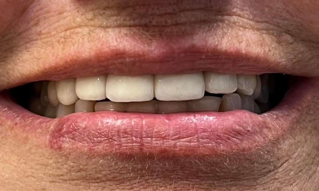 implants in Vienna- After Photo