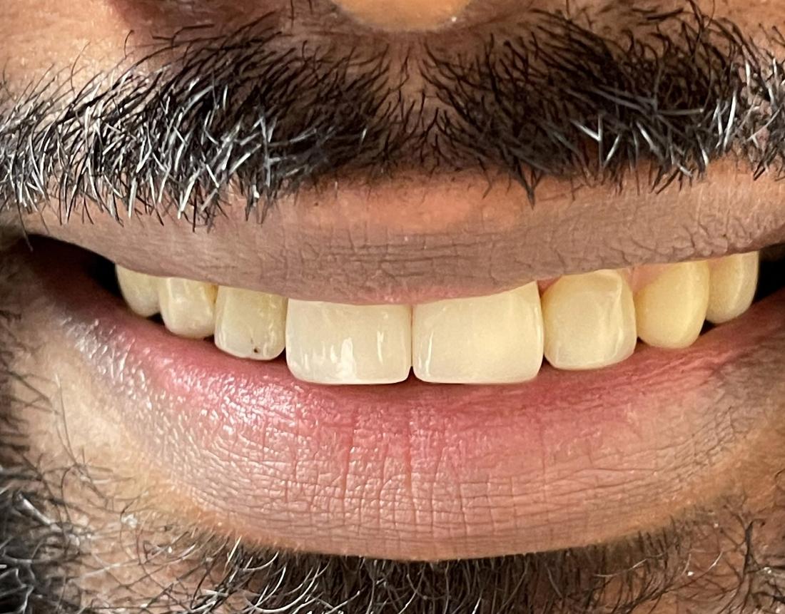 veneer treatment in Vienna