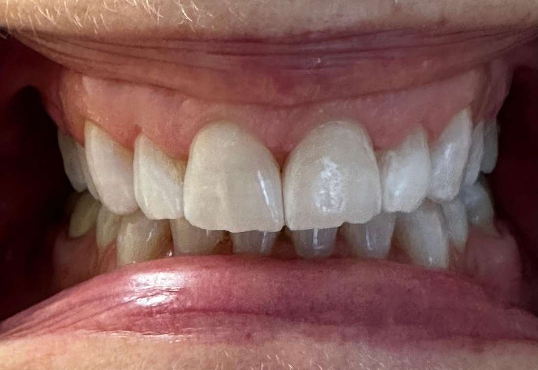 Teeth whitening in Vienna- After Photo