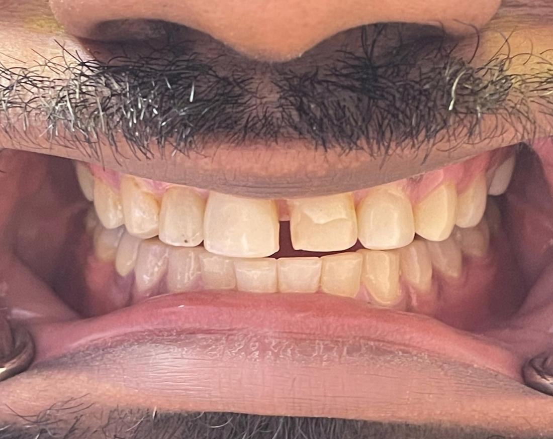 veneers in Vienna