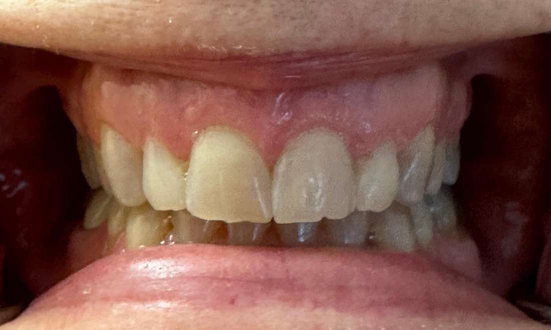 Teeth whitening in Vienna- Before Photo