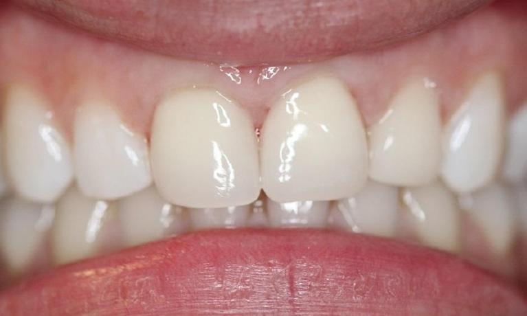 natural looking front tooth, produced by a CEREC crown | dental crowns vienna va