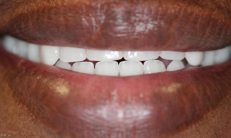 Complete-Dentures-After-Image