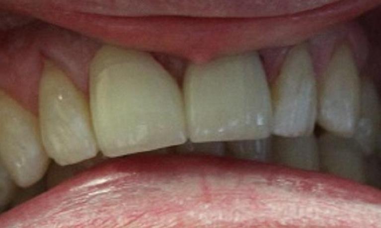 chipped an discolored front teeth, fully restored with porcelain crowns | vienna va cosmetic dentist