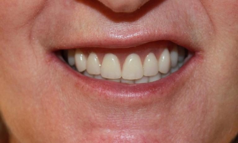 Hybrid-Dentures-After-Image