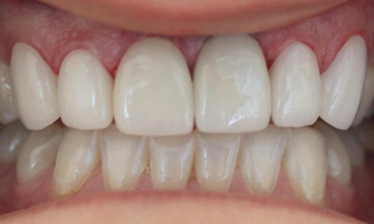patients mouth after receiving a dental implant crown and bridge | dental implants in vienna