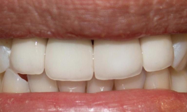 a new dental implant with a crown, that blends seamlessly into the patients smile | dental implants vienna