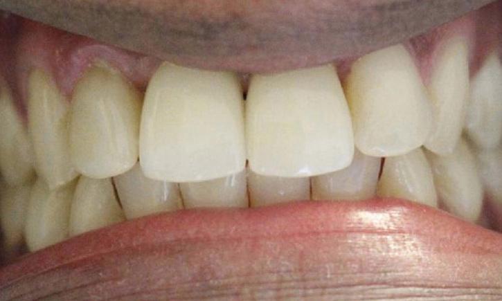 a newly restored missing front tooth and chipped front teeth thanks to porcelain crowns | crowns in vienna va