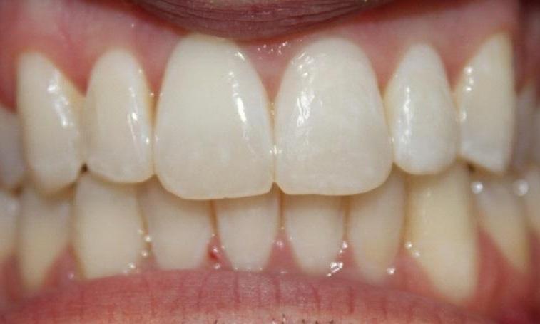 teeth after an invisalign treatment | invisalign vienna va