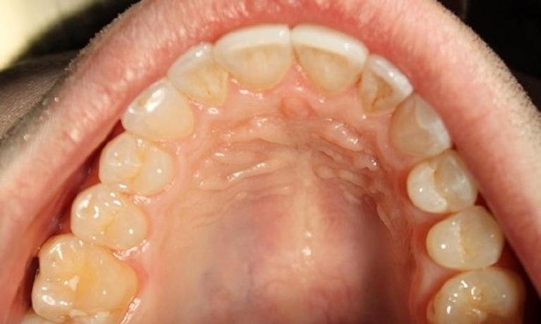 teeth after an invisalign treatment at our office | invisalign treatment vienna va