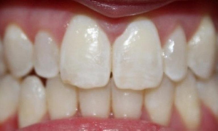 a patients upper teeth after invisalign treatment | invisalign dentist in vienna