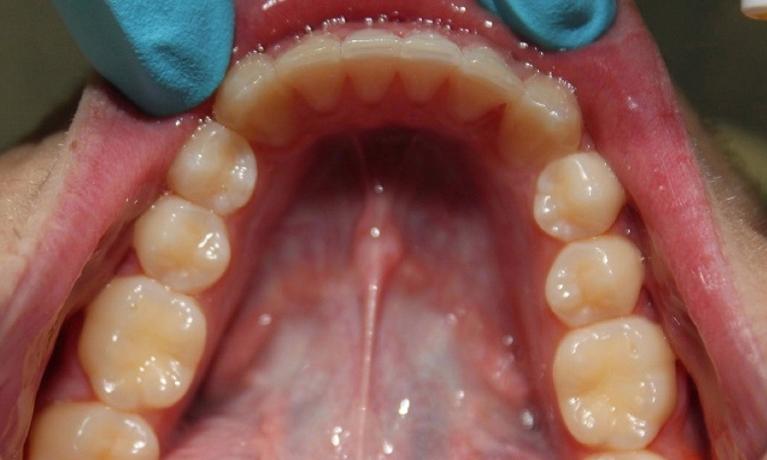 lower set of teeth after an invisalign treatment | vienna va invisalign dentist
