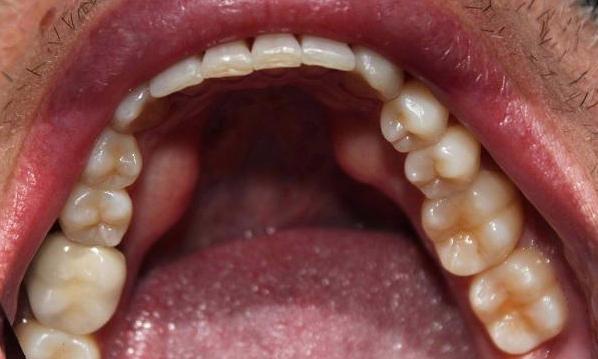 aligned lower teeth after an invisalign treatment with our office | vienna va invisalign treatment