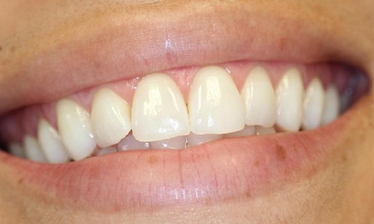 a smile after kor teeth whitening | professional teeth whitening vienna va