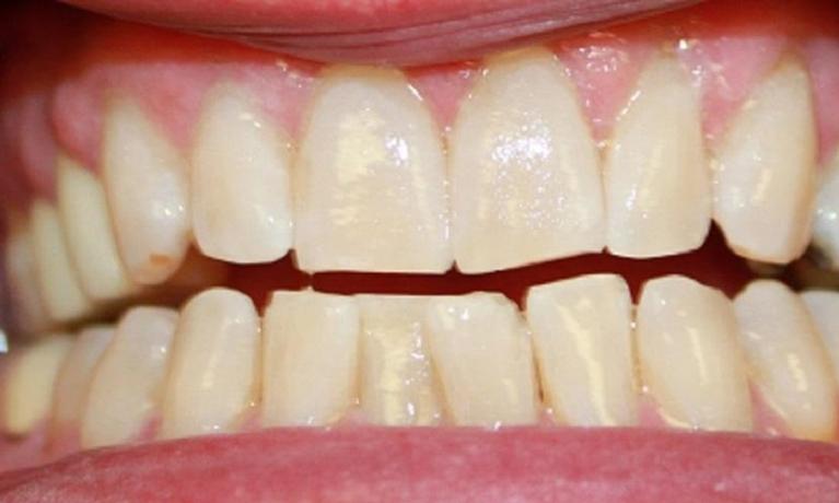 teeth after a laser whitening treatment | laser teeth whitening in vienna va