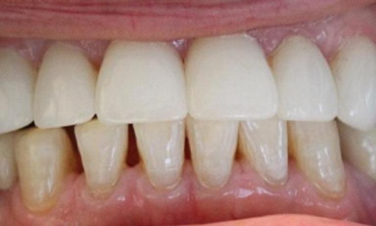 teeth after laser teeth whitening and crown procedures from our vienna office | laser teeth whitening in vienna va