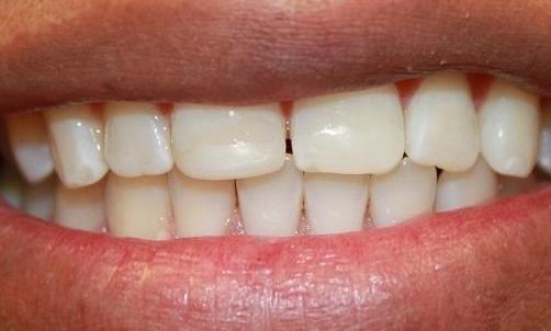 teeth after a laser whitening treatment from our office | laser whitening dentist in vienna va