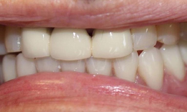 Overdenture-After-Image