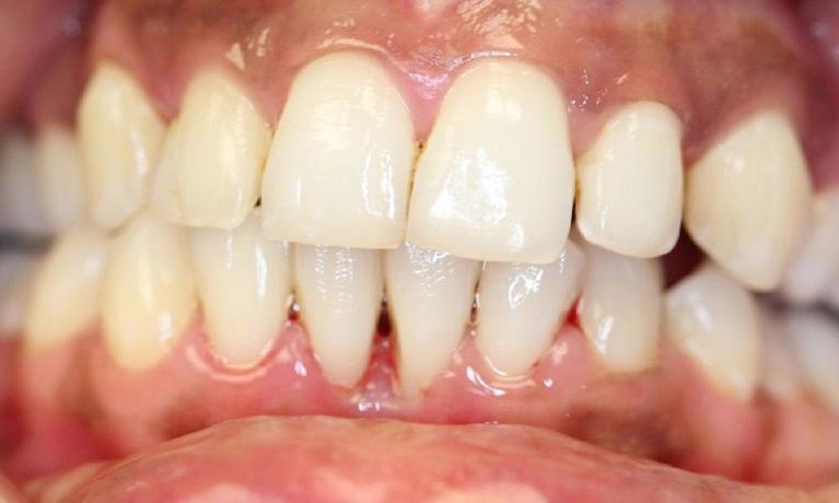Periodontal-Treatment-After-Image