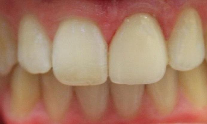a tooth, lengethened after a porcelain crown | dental crowns in vienna