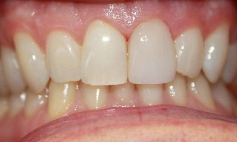 a chipped front tooth repaired by a porcelain crown