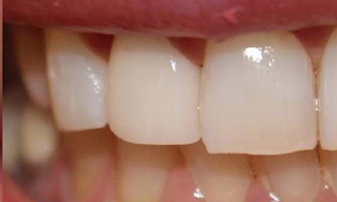 Porcelain-Crown-After-Image